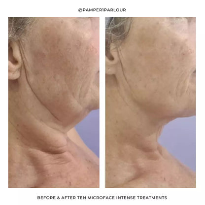 Silhouette Microface Intense - Everything Wellness