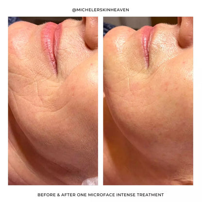 Silhouette Microface Intense - Everything Wellness