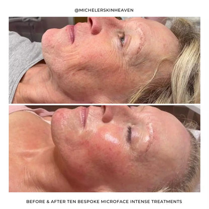 Silhouette Microface Intense - Everything Wellness