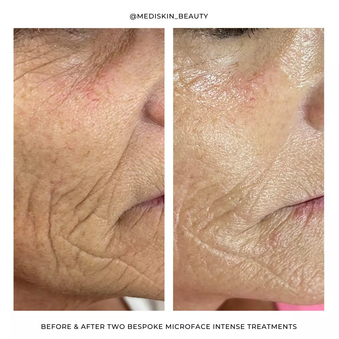 Silhouette Microface Intense - Everything Wellness