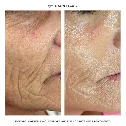Silhouette Microface Intense - Everything Wellness